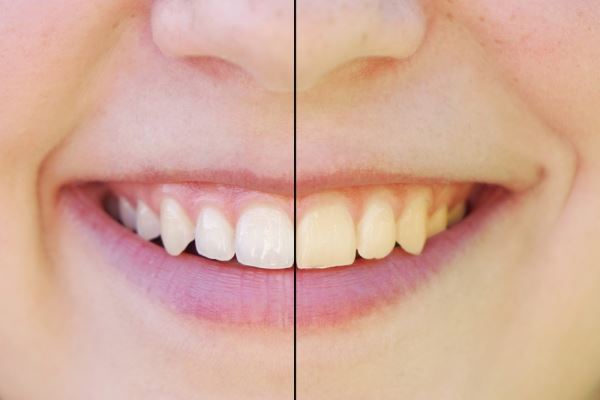 Правда ли, что здоровые зубы должны быть белыми